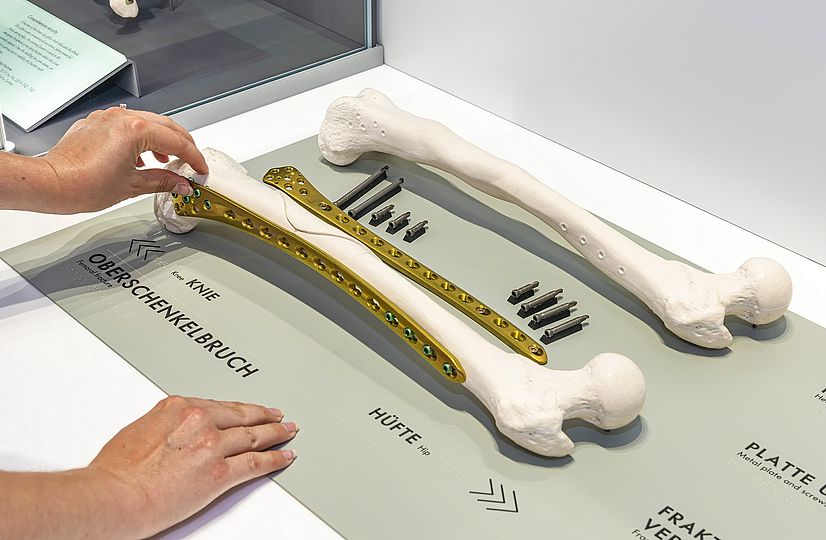 Knochenbruch Knochenbruch Ausstellung Gesundheit