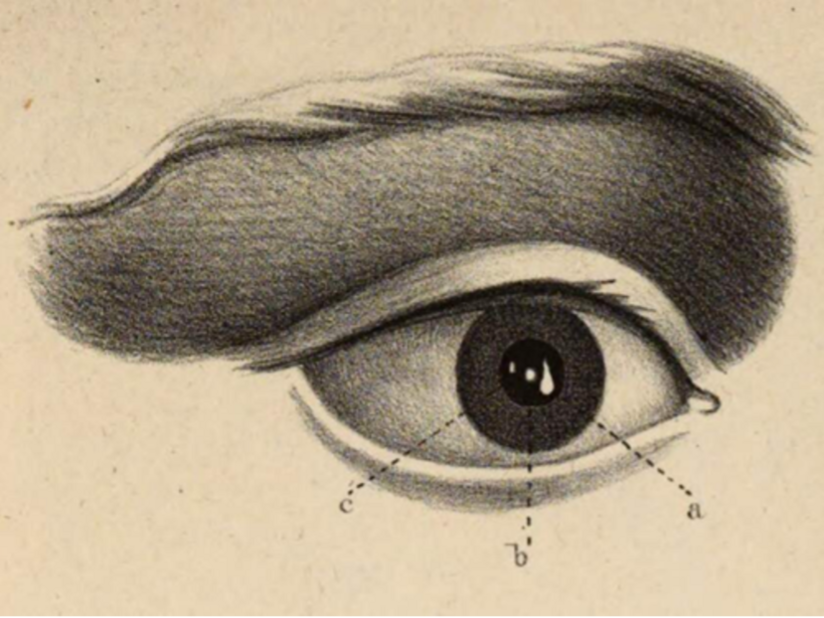 Darstellung der drei Purkinje-Sanson-Bilder.